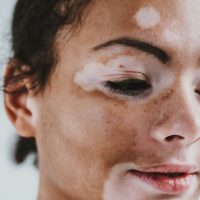 Vitiligo Camouflaging