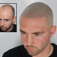 Scalp Micropigmentation