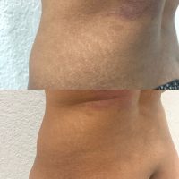 Stretch Mark Cover-Up